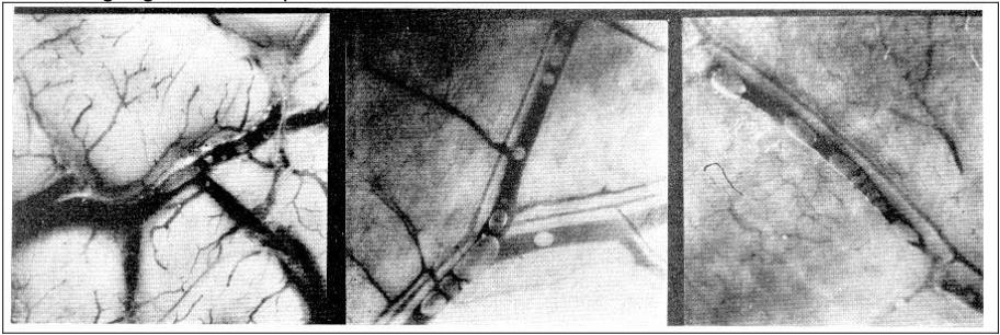Abb. 5.8: Bläschenbildung in Blutgefäßen nach Drucksturz
